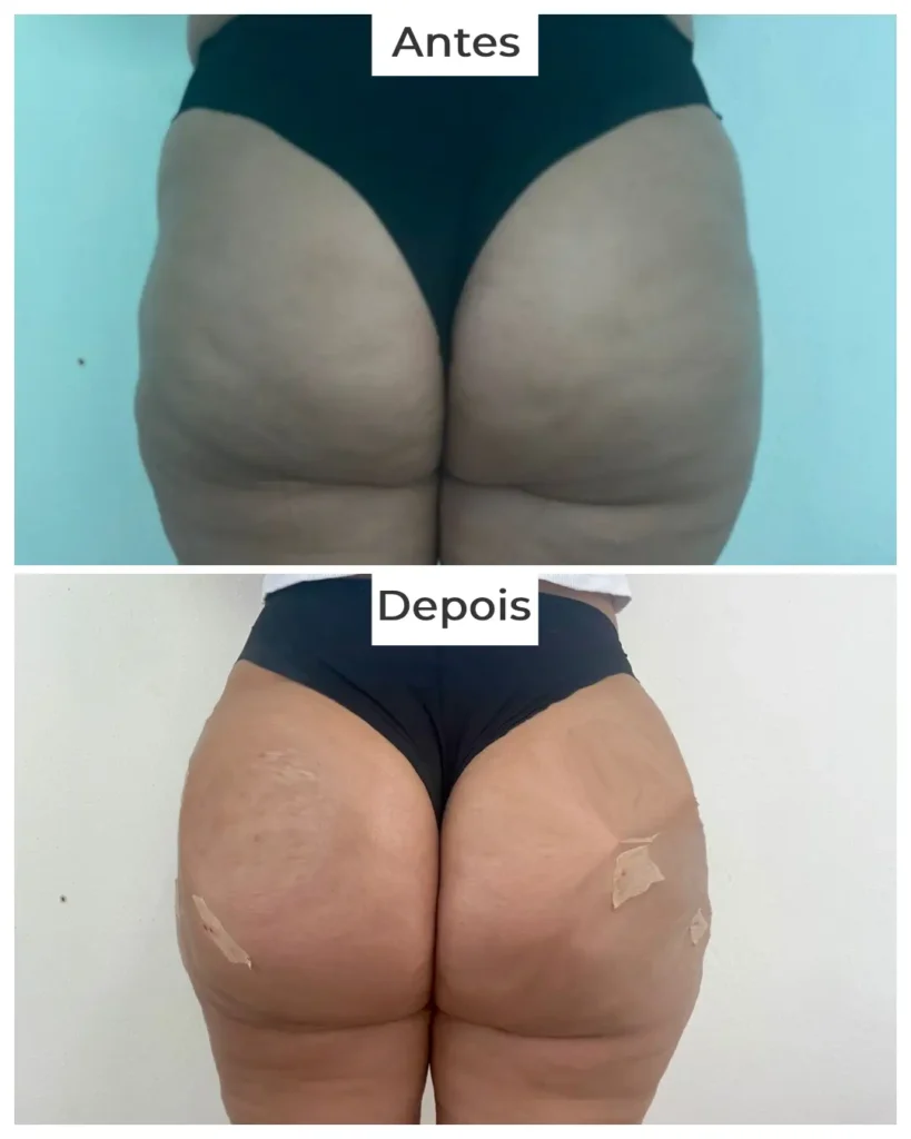 harmonizacao-de-gluteos-profissionais-em-df