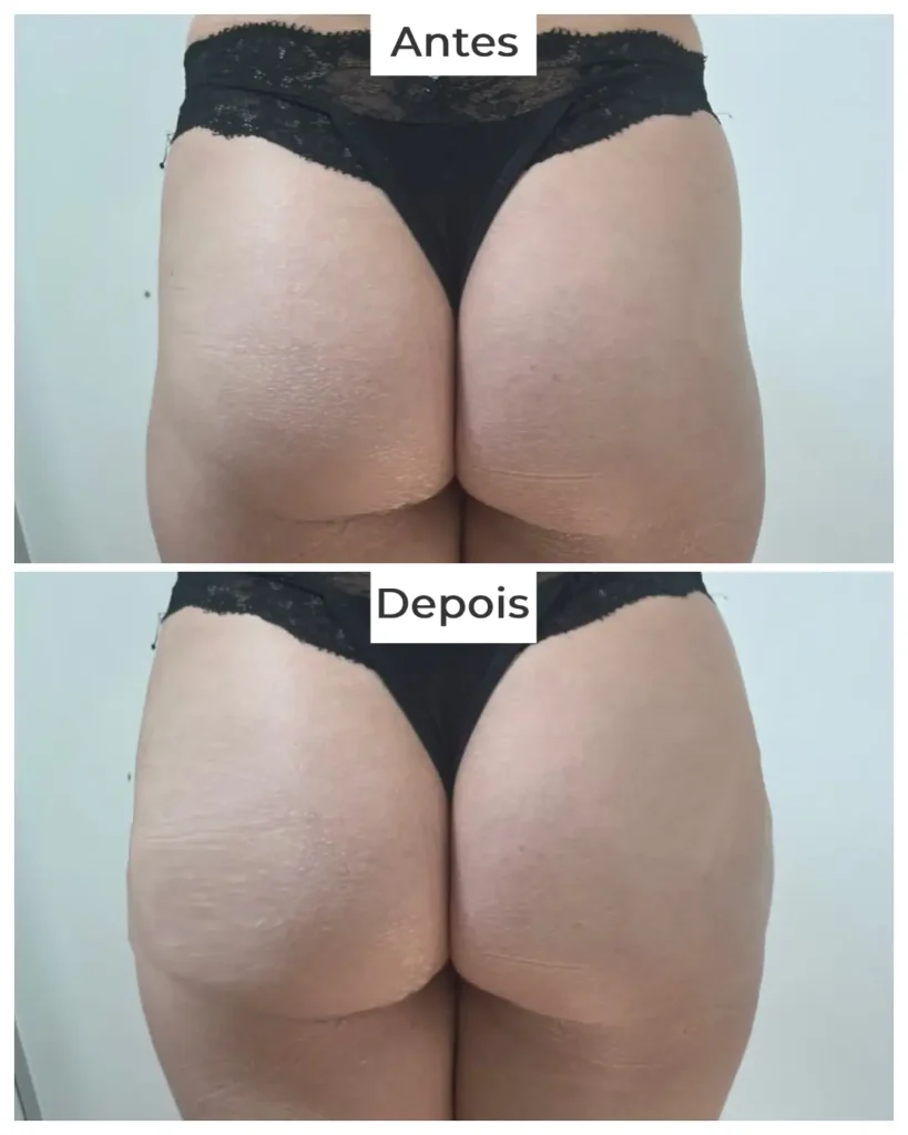 clinica-de-harmonizacao-de-gluteos-brasilia