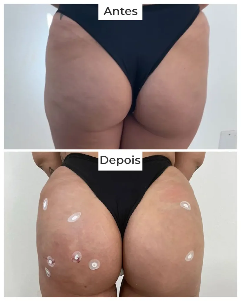 antes-e-depois-harmonizacao-de-gluteos-df